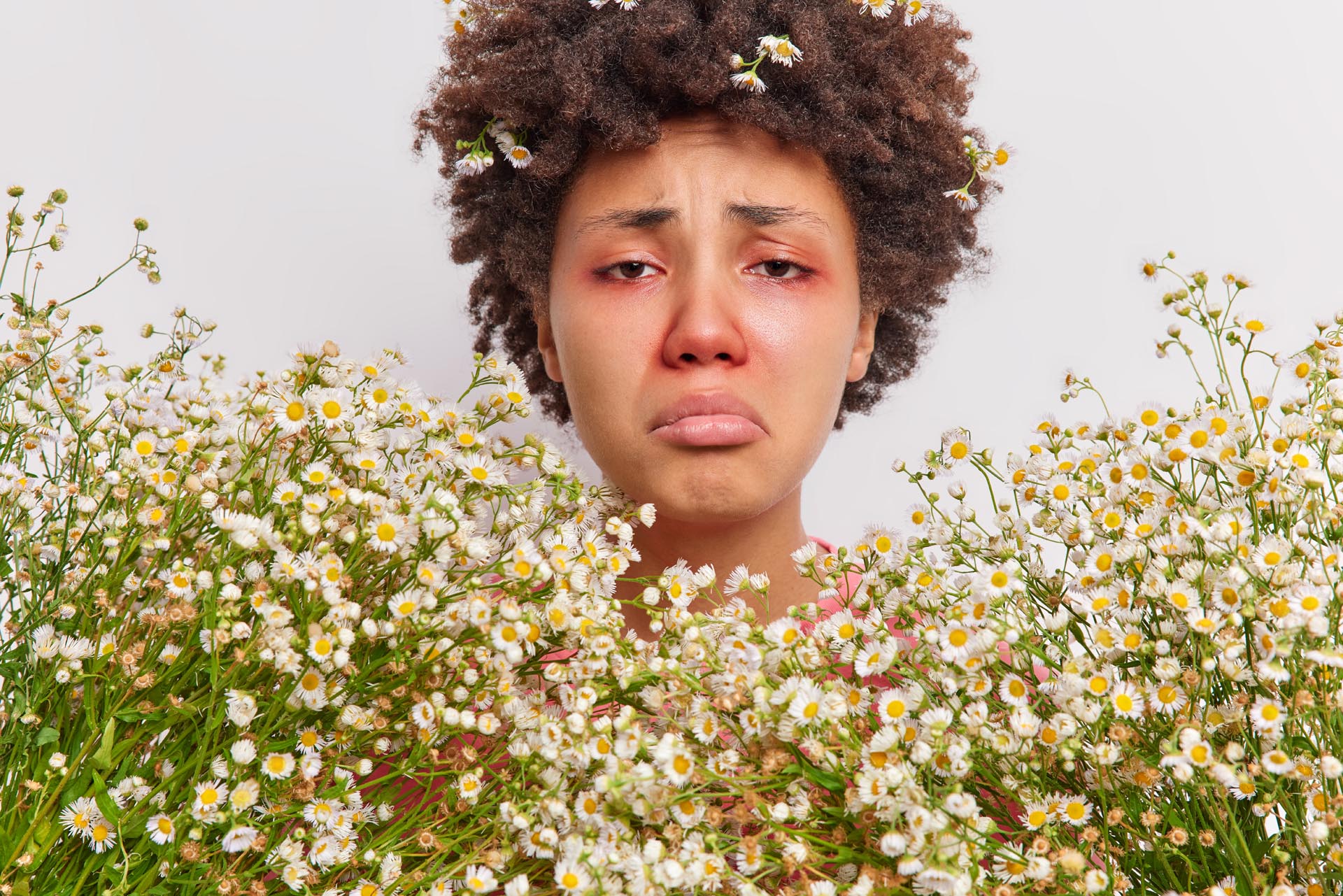 Close up shot of frustrated curly haired Afro American woman surrounded by camomile flowers has red swollen eye srunny nose suffers from seasonal pollen allergy needs consultancy of immunologist